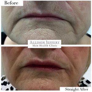 Botox Marionette Lines Before And After (9)