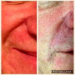 Botox Nasolabial Folds Before And After Photos (2)