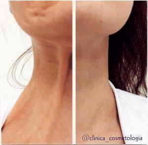 Botox Neck Treatment Pre And Post (2)