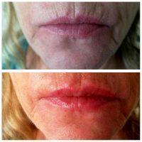Botox On Smokers Lines Before And After Photos (1)