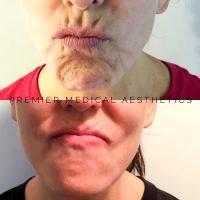 Botox On Smokers Lines Before And After Photos (17)