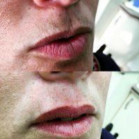 Botox On Smokers Lines Before And After Photos (8)