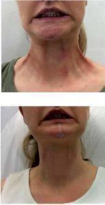 Botox To Neck Muscles
