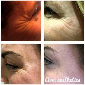 Botox To Prevent Crow's Feet Picture