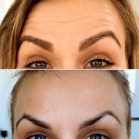 Botox To Prevent Forehead Wrinkles