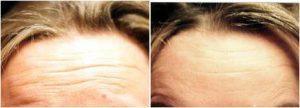 Botox To The Horizontal Forehead Creases By Anita Mandal, M.D., Doctor In Palm Beach Gardens, Florida