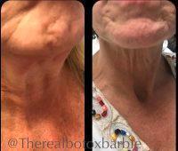 Botox To Tighten Under Chin