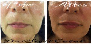 Botox To Treat Marionette Lines Before And After (1)