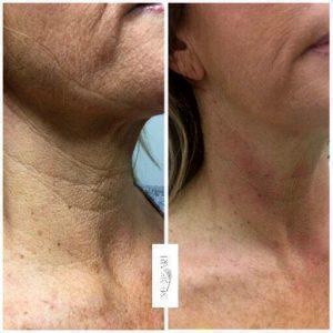 Botox Vertical Neck Bands Before And After