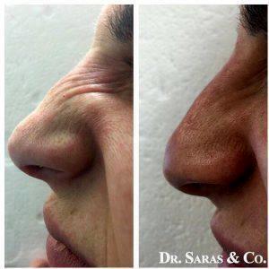 Bunny Lines Botox Treatment Pre And Post Treatment (3)