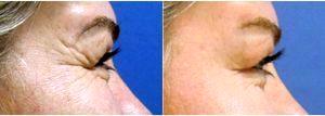 Doctor Allen Rezai, MD, London Plastic Surgeon - 39 Year Old Woman Treated Crows Feet With Botox
