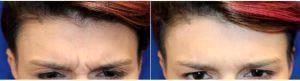 Dr Matthew Richardson, MD, Frisco Facial Plastic Surgeon - 41 Year Old Woman Treated With Botox 11 Lines