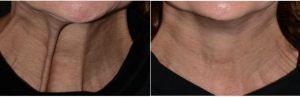 Dr. Amit Bhrany, MD, Seattle Facial Plastic Surgeon - Botox For Neck Platysma Bands