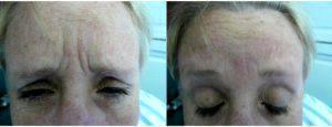 Dr. Kimberley Lloyd O'Sullivan, MD, Providence Plastic Surgeon - 43 Year Old Woman Treated With Botox 11 Lines