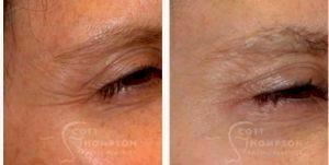 Dr. Scott K. Thompson, MD, Salt Lake City Facial Plastic Surgeon - 40 Year Old Woman Treated With Botox Crows Feet