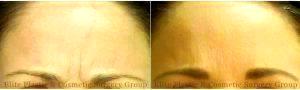 Female Patient Treated With Botox In Frown Lines (Glabella) Before & After By Dr