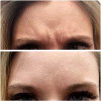 Frown Lines Can Be Improved With Botox In Combination With Fillers And Microneedling