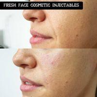Injectable Fillers Nasolabial Folds