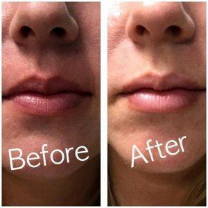 Lip Augmentation At Avalon Laser, Skin Care Clinic In San Diego, California