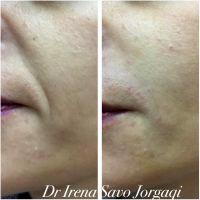 Nasolabial Folds Before And After Filler