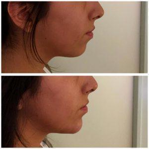 Non Surgical Chin Enhancement With Radiesse By Los Angeles Cosmetic Surgeon Dr. Alexander Rivkin