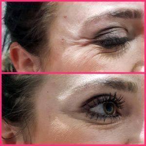 Preventative Botox For Crow's Feet Before And After