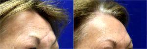 Restylane Filler For Scar By Dr. S. Randolph Waldman, Lexington Facial Plastic Surgeon (3)