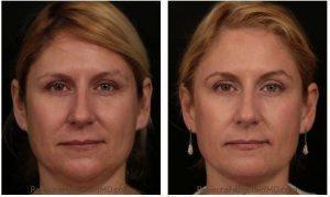 Restylane Lyft, Kybella And Dysport By Dr. Rebecca Fitzgerald, Cosmetic Dermatologist In Los Angeles, Beverly Hills, Larchmont (1)