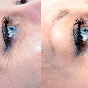 Should You Get Botox Under Your Eyes