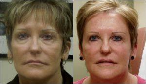 63 Year Old Female Underwent Correction Of Her Tear Trough Depressions With 2 Syringes Of Restylane By Dr. Rottman, MD,Baltimore