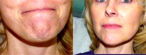Botox Chin-Ripples At The Maryland Dermatology Laser, Skin And Vein Institute,Baltimore