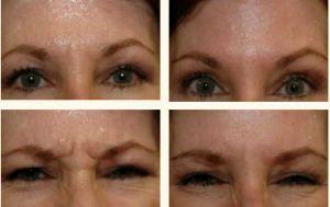 Botox Injections By Dr. Greenberg,M.D.,Orlando