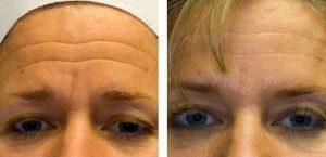 Botox Injections By Dr. Lamperti MD,Seattle