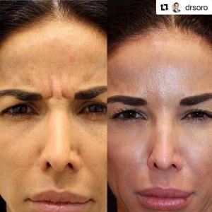 Botox Injections By Dr. Shino Bay Aguilera, Fort Lauderdale
