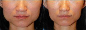 Botox To Decrease The Prominence Of The Angle Of The Jaws By Dr. Philip Young MD, Seattle