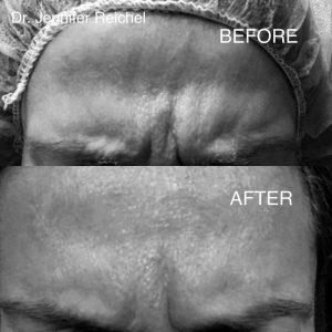 Botox Treatment Of The Wrinkles Between Eyebrows By Dr. Jennifer Reichel MD, Seattle