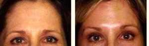 Brow Lift With Botox By Dr. Greenberg,M.D.,Orlando