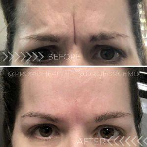 Correction Of The Glabellar Frown Line With Botox By George Gavrila, MD,Baltimore