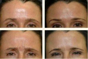 Correction Of The Grabella Wrinkles With Botox By Dr. Greenberg,M.D.,Orlando