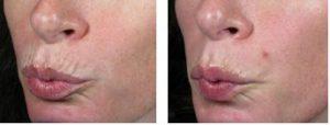 Dermatology Treatments With Botox By DEIRDRE O'BOYLE HOOPER, M.D,New Orleans