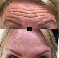 Dr. George H. Pope, Orlando Plastic Surgeon Botox Facial Injections