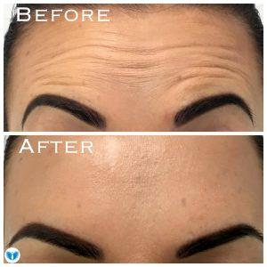 Forehead Wrinkles Treated With Botox At NewDermaMed,Toronto