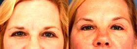 Glabella Line Treatment With Botox By Dr. Schuster's,MD,Baltimore
