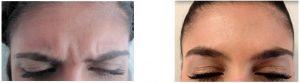 This Patient Had The Vertical Frown Lines Treated With Botox. These Are Also Known As 11 Line At NewDermaMed,Toronto