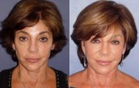 Dr Maurice P. Sherman, MD, San Diego Facial Plastic Surgeon - Sculptra Before 215