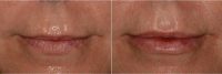 Natural, Soft, And Pillowy Lips With Restylane Silk Before By Dr Andrea Hui, MD, San Francisco Dermatologic Surgeon