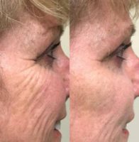 24 to 65 year old women treated with Botox