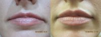 26 Year Old Female Treated for Lip Enhancement