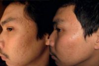 35-44 year old man treated with Acne Scars Treatment