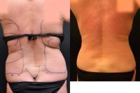 35-44 year old woman treated with Laser Liposuction for Bra Rolls